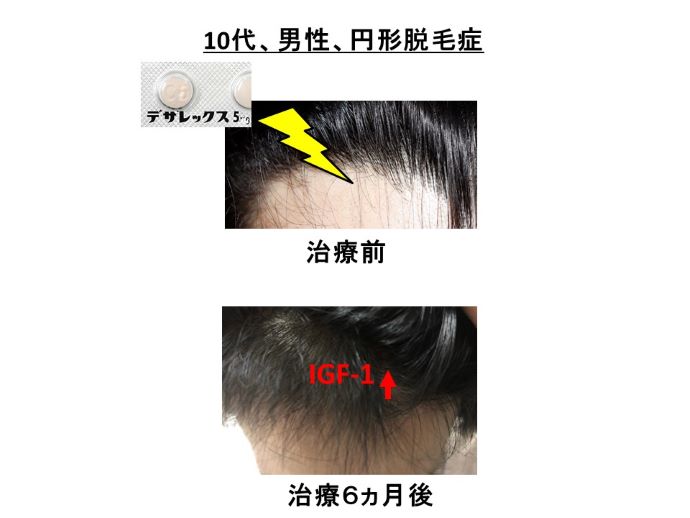 円形脱毛症　病院